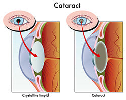 Scheduled to have cataract surgery? — ReadingGlasses.CO/
